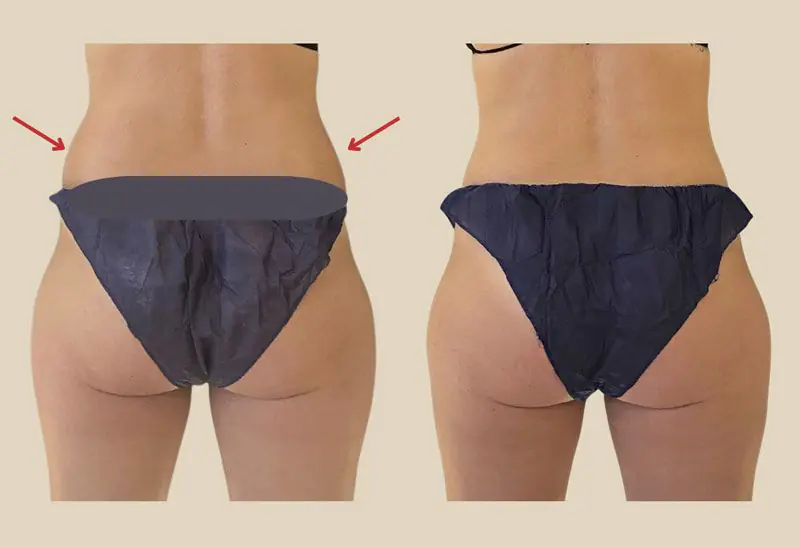 Resultados Antes y Después Criolipólisis